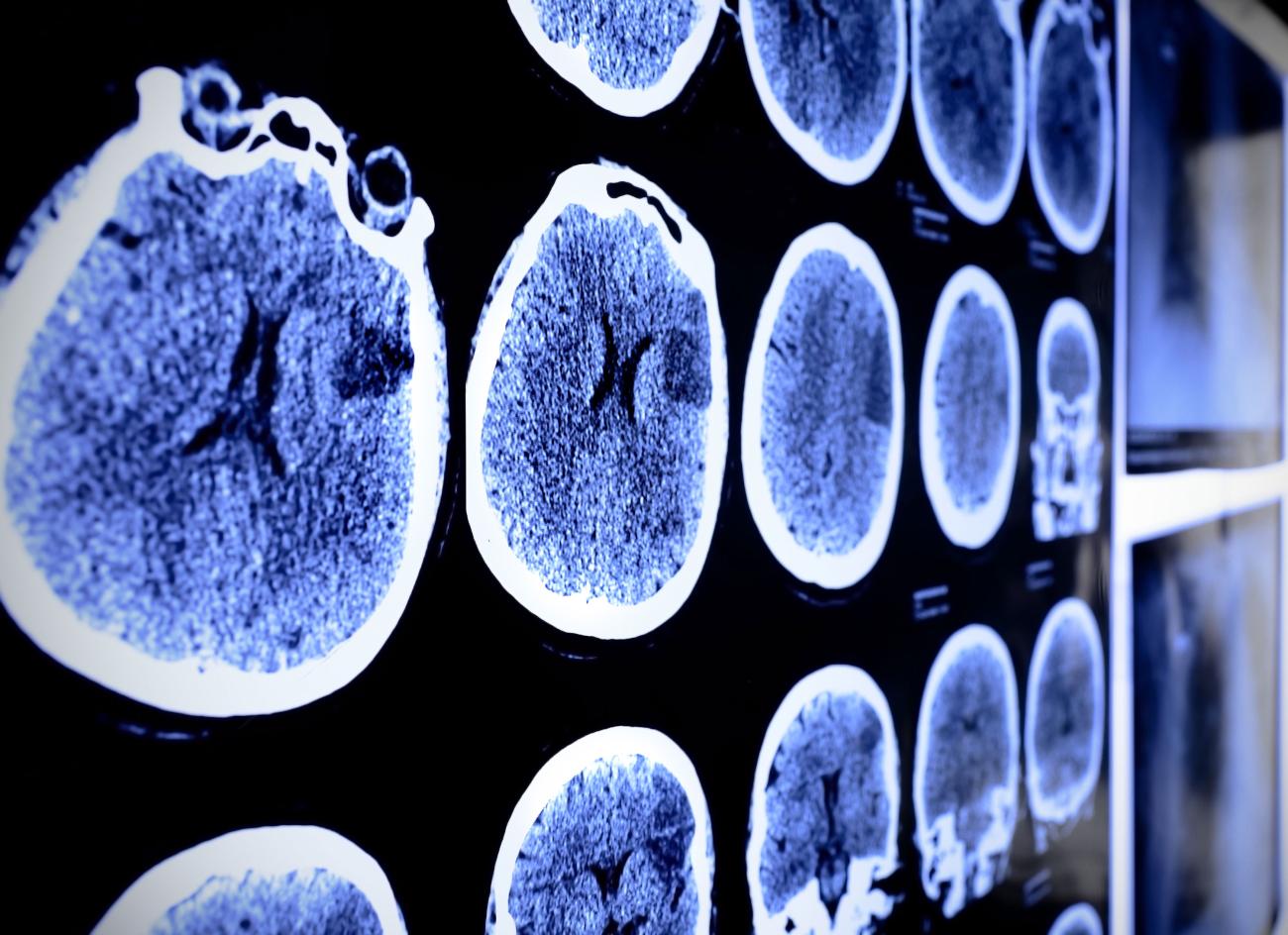 Image of brain scan