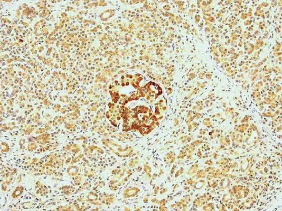 Pancreatic Cancer Tissue Section