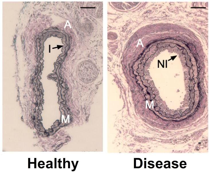 Healthy and Unhealthy Blood Vessel